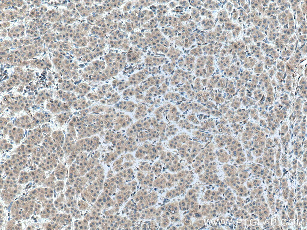IHC staining of human liver cancer using 16108-1-AP