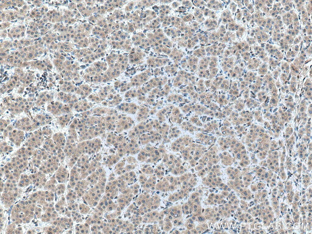 Immunohistochemistry (IHC) staining of human liver cancer tissue using ERGIC1 Polyclonal antibody (16108-1-AP)