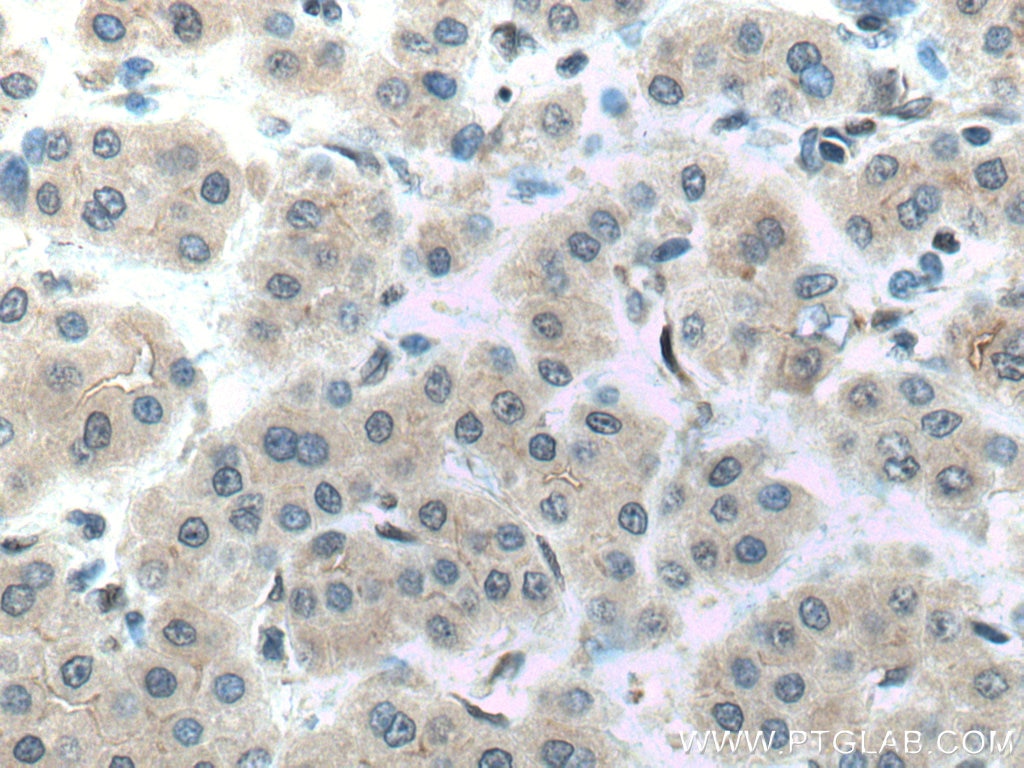 Immunohistochemistry (IHC) staining of human liver cancer tissue using ERGIC1 Polyclonal antibody (16108-1-AP)