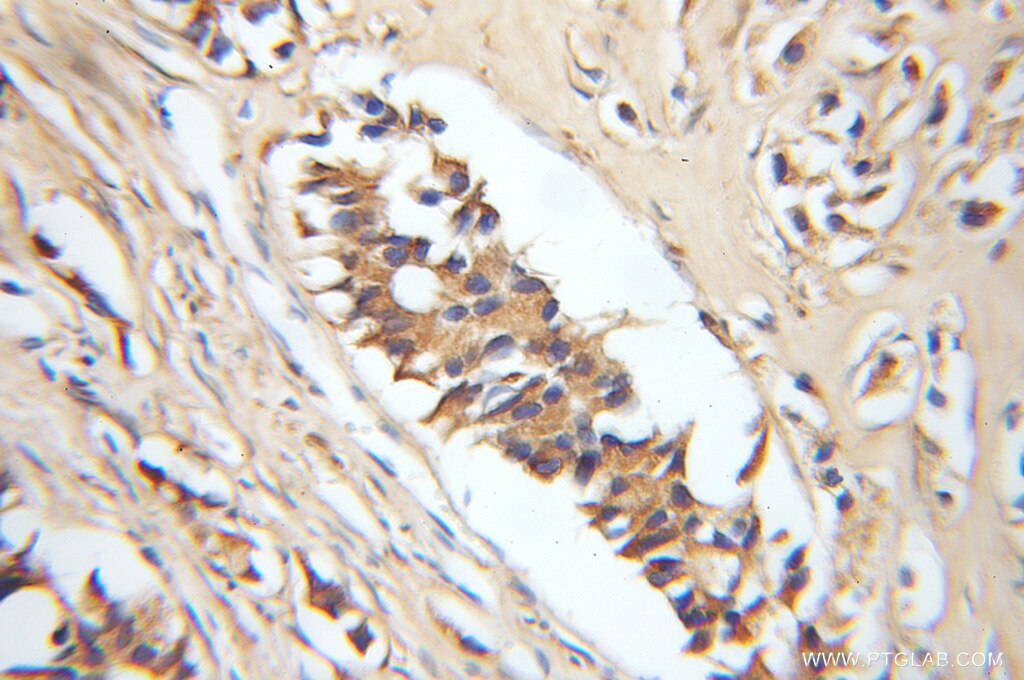 Immunohistochemistry (IHC) staining of human prostate cancer tissue using ERGIC2 Polyclonal antibody (11927-1-AP)