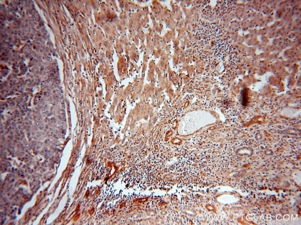 Immunohistochemistry (IHC) staining of human liver cancer tissue using ERI1 Polyclonal antibody (14592-1-AP)