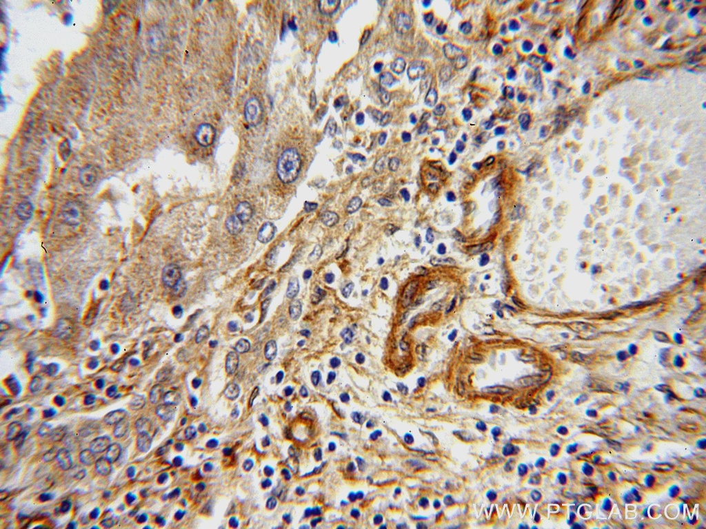 Immunohistochemistry (IHC) staining of human liver cancer tissue using ERI1 Polyclonal antibody (14592-1-AP)