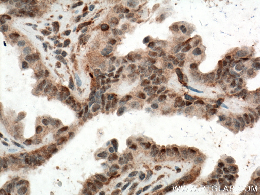 Immunohistochemistry (IHC) staining of human ovary tumor tissue using ERK1/2 Monoclonal antibody (66192-1-Ig)