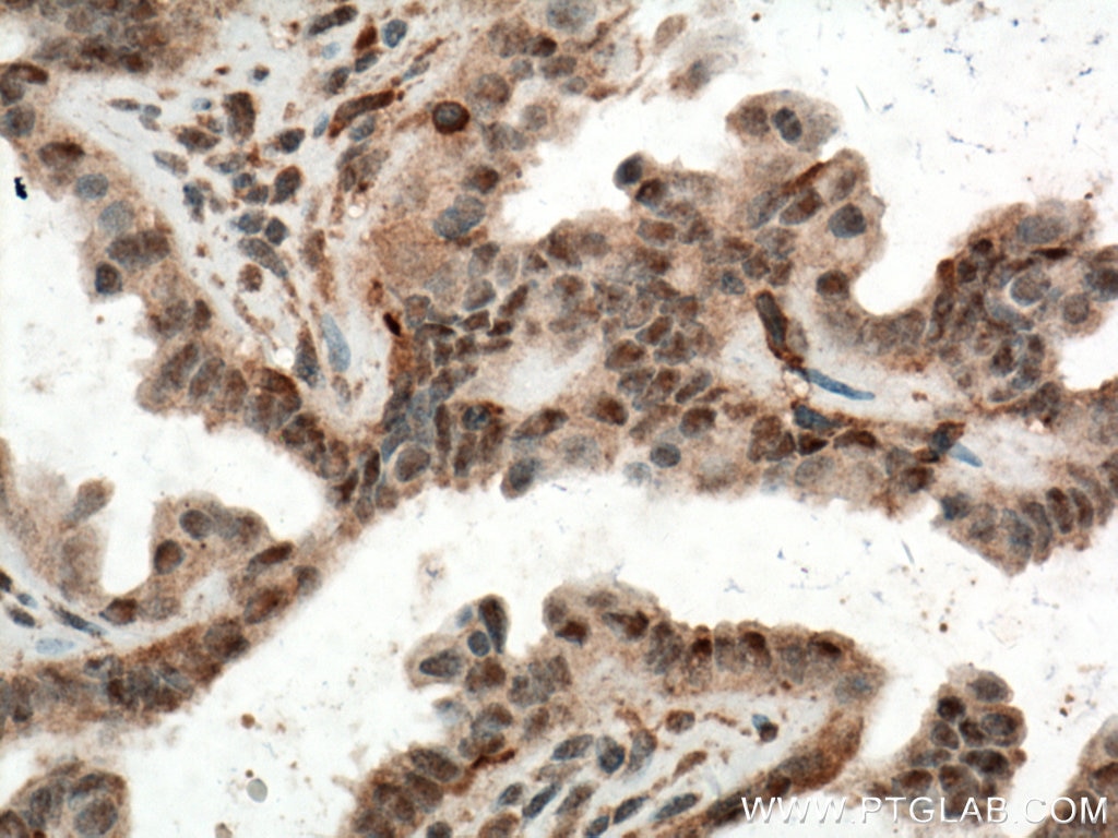 Immunohistochemistry (IHC) staining of human ovary tumor tissue using ERK1/2 Monoclonal antibody (66192-1-Ig)