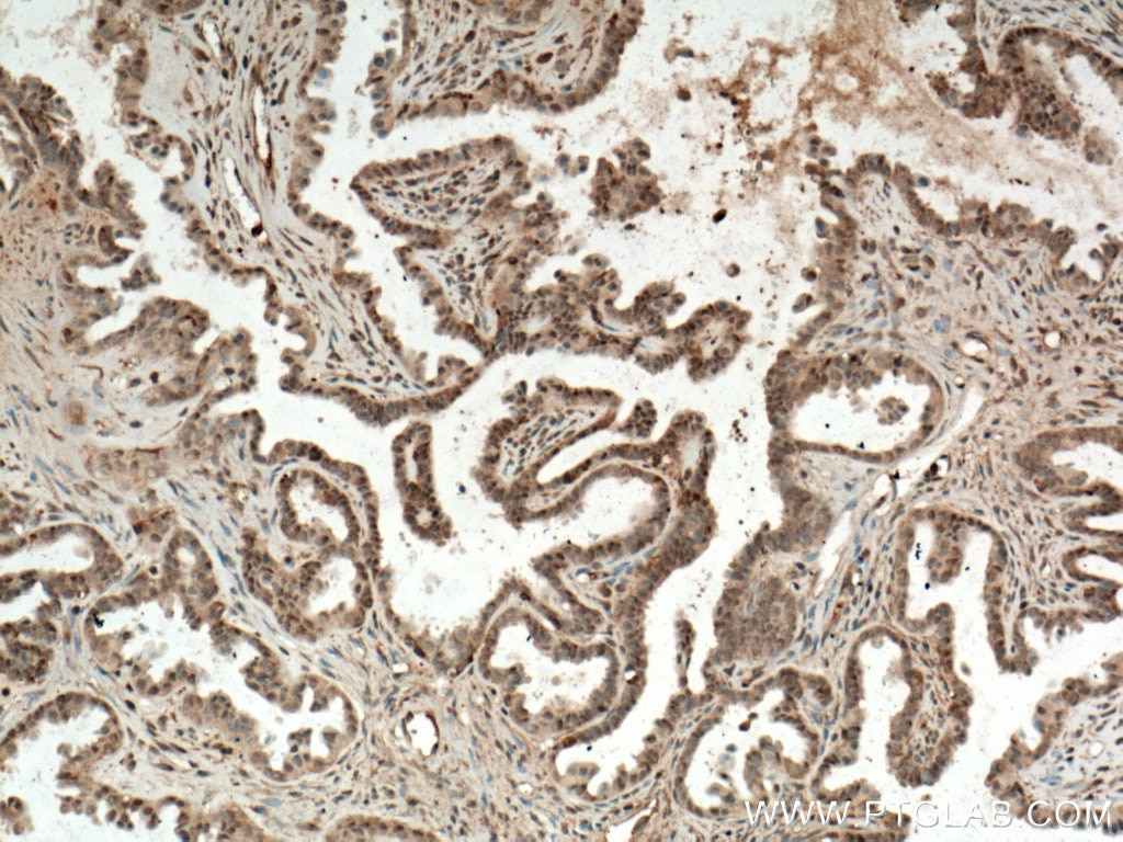 Immunohistochemistry (IHC) staining of human ovary tumor tissue using ERK1/2 Monoclonal antibody (66192-1-Ig)