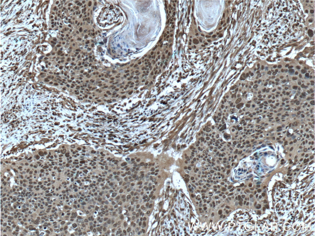 Immunohistochemistry (IHC) staining of human cervical cancer tissue using ERK1/2 Monoclonal antibody (66192-1-Ig)