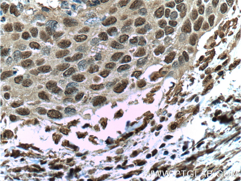Immunohistochemistry (IHC) staining of human cervical cancer tissue using ERK1/2 Monoclonal antibody (66192-1-Ig)