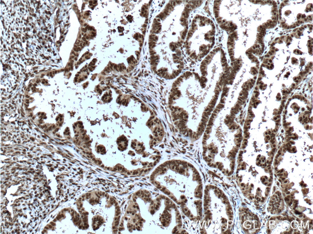 Immunohistochemistry (IHC) staining of human ovary tumor tissue using ERK1/2 Monoclonal antibody (66192-1-Ig)