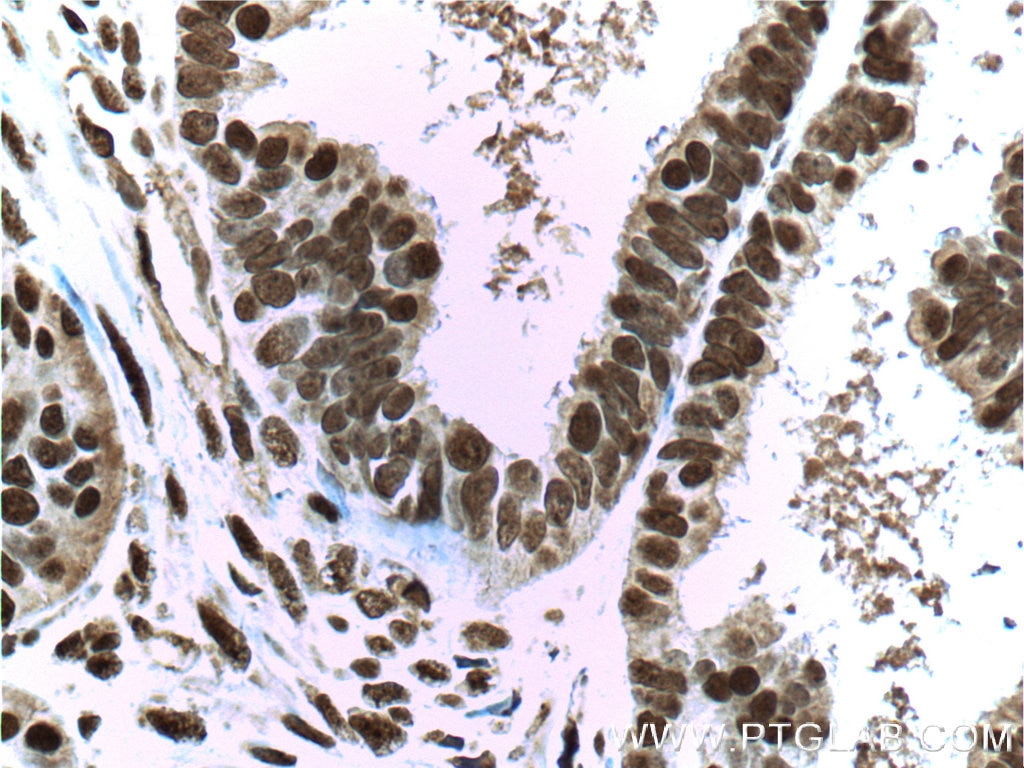 Immunohistochemistry (IHC) staining of human ovary tumor tissue using ERK1/2 Monoclonal antibody (66192-1-Ig)