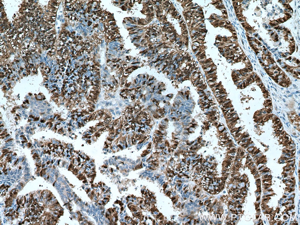Immunohistochemistry (IHC) staining of human ovary tumor tissue using ERK1/2 Monoclonal antibody (67170-1-Ig)