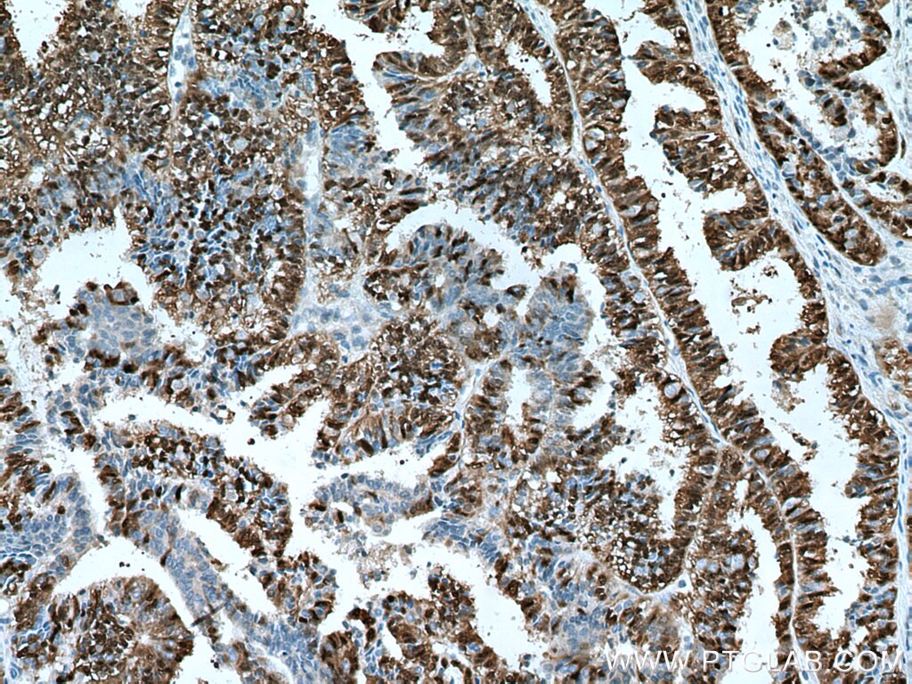 IHC staining of human ovary tumor using 67170-1-Ig