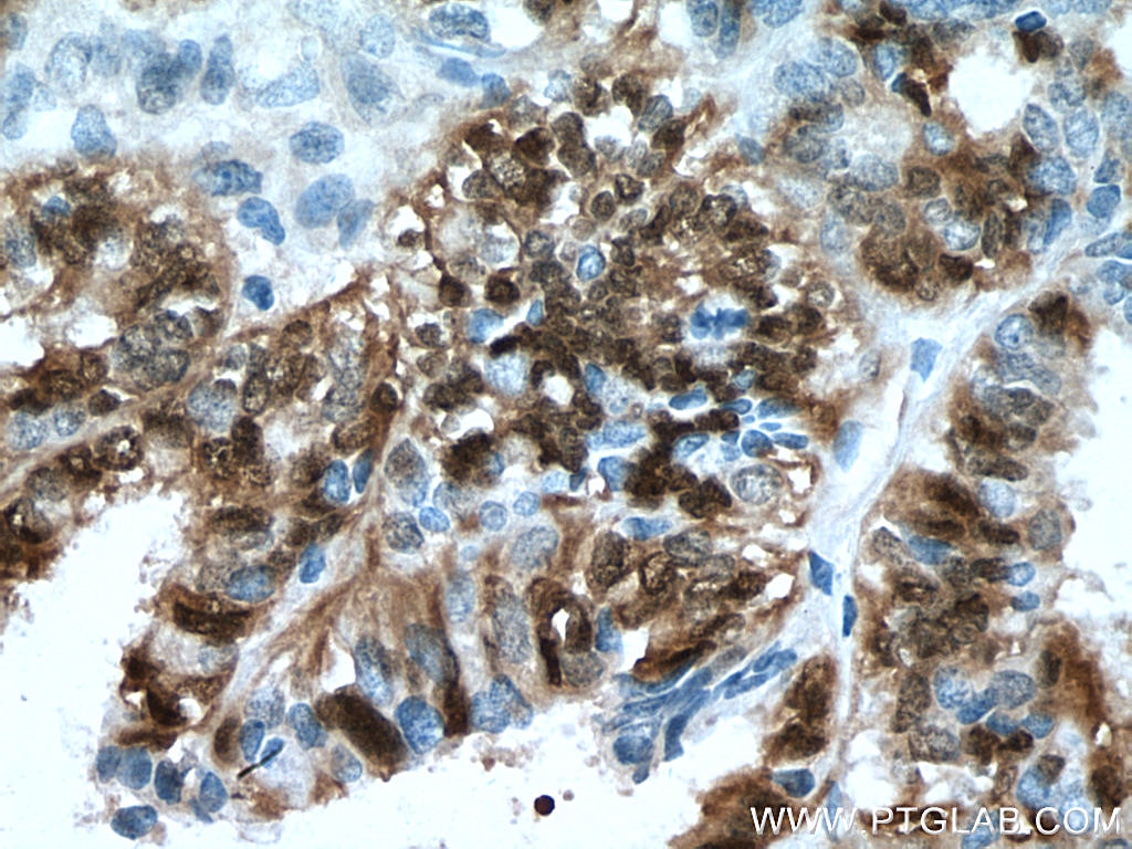 Immunohistochemistry (IHC) staining of human ovary tumor tissue using ERK1/2 Monoclonal antibody (67170-1-Ig)