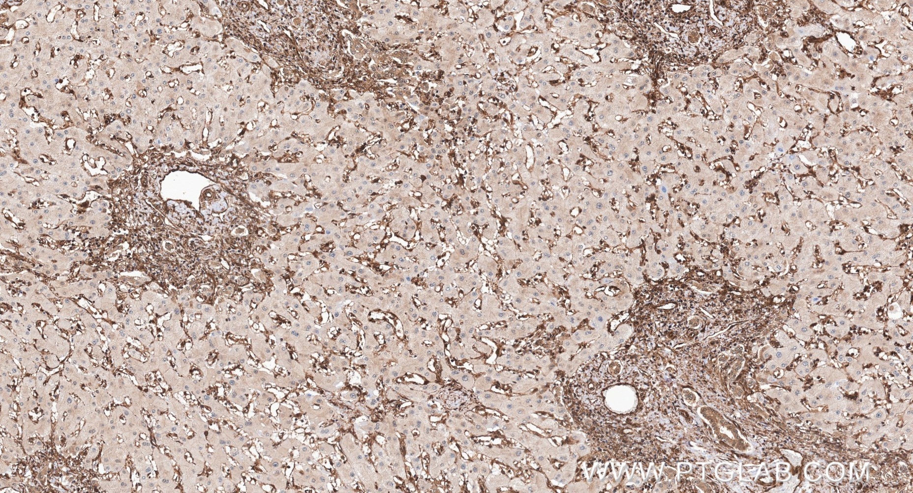IHC staining of human liver cancer using 83533-1-RR Immunohistochemistry (IHC) staining of human liver cancer tissue using ERK1/2 Recombinant monoclonal antibody (83533-1-RR)
