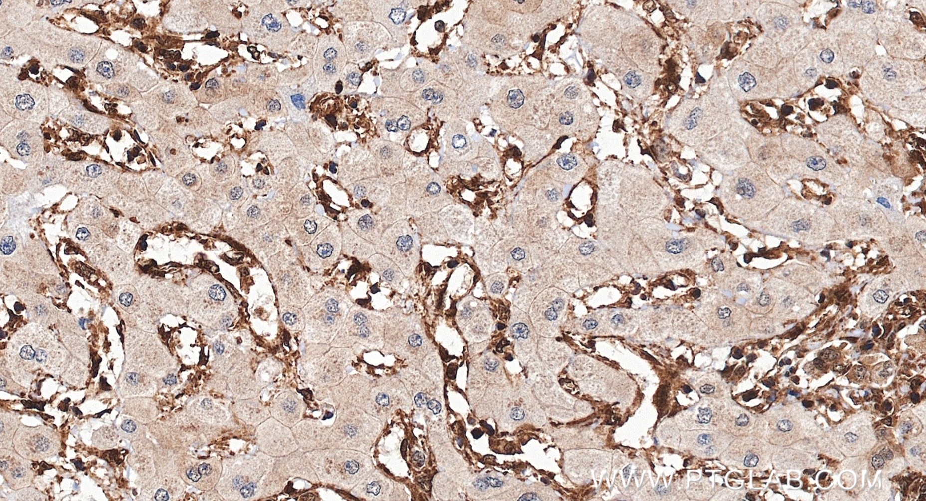 IHC staining of human liver cancer using 83533-1-RR Immunohistochemistry (IHC) staining of human liver cancer tissue using ERK1/2 Recombinant monoclonal antibody (83533-1-RR)