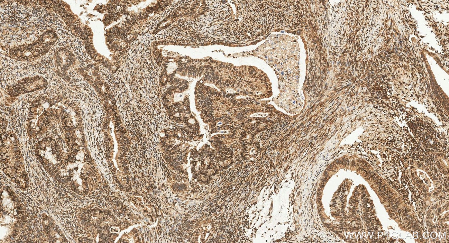 Immunohistochemistry (IHC) staining of human colon cancer tissue using Phospho-ERK1/2 (Thr202/Tyr204) Polyclonal antibody (28733-1-AP)