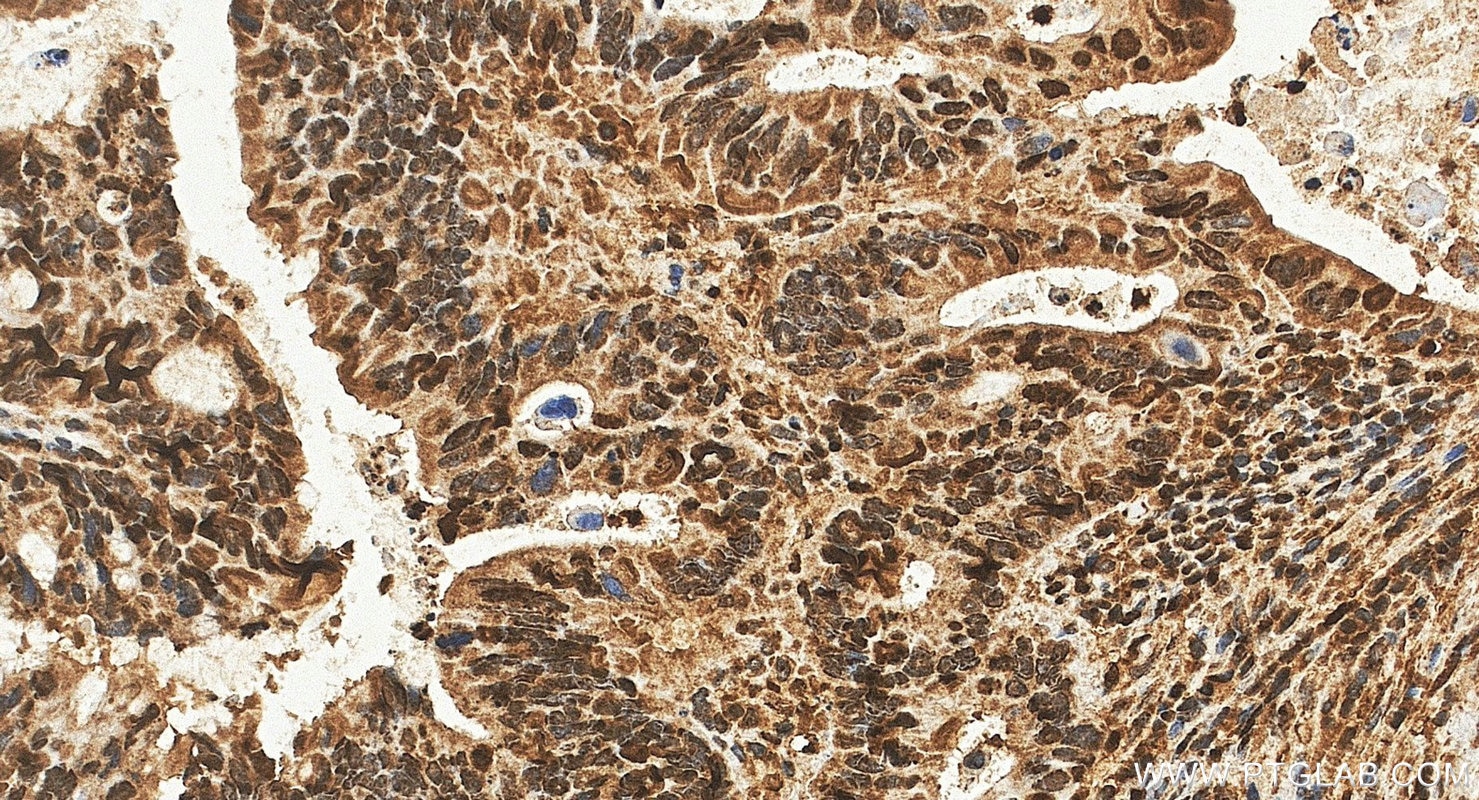 Immunohistochemistry (IHC) staining of human colon cancer tissue using Phospho-ERK1/2 (Thr202/Tyr204) Polyclonal antibody (28733-1-AP)