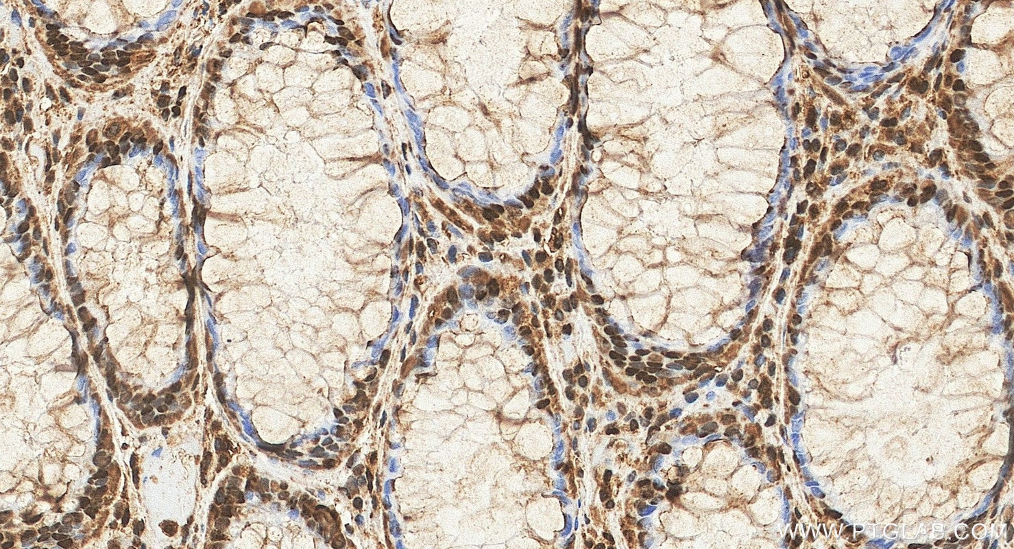 Immunohistochemistry (IHC) staining of human colon cancer tissue using Phospho-ERK1/2 (Thr202/Tyr204) Polyclonal antibody (28733-1-AP)