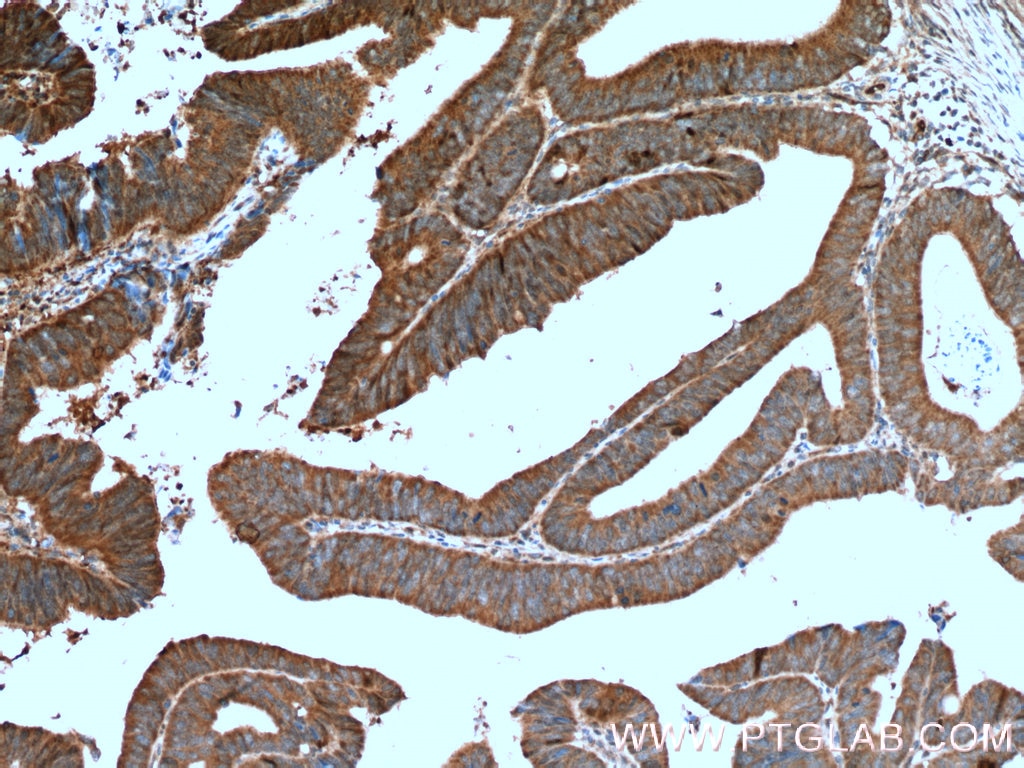 Immunohistochemistry (IHC) staining of human colon cancer tissue using ERK1/2 Polyclonal antibody (11257-1-AP)