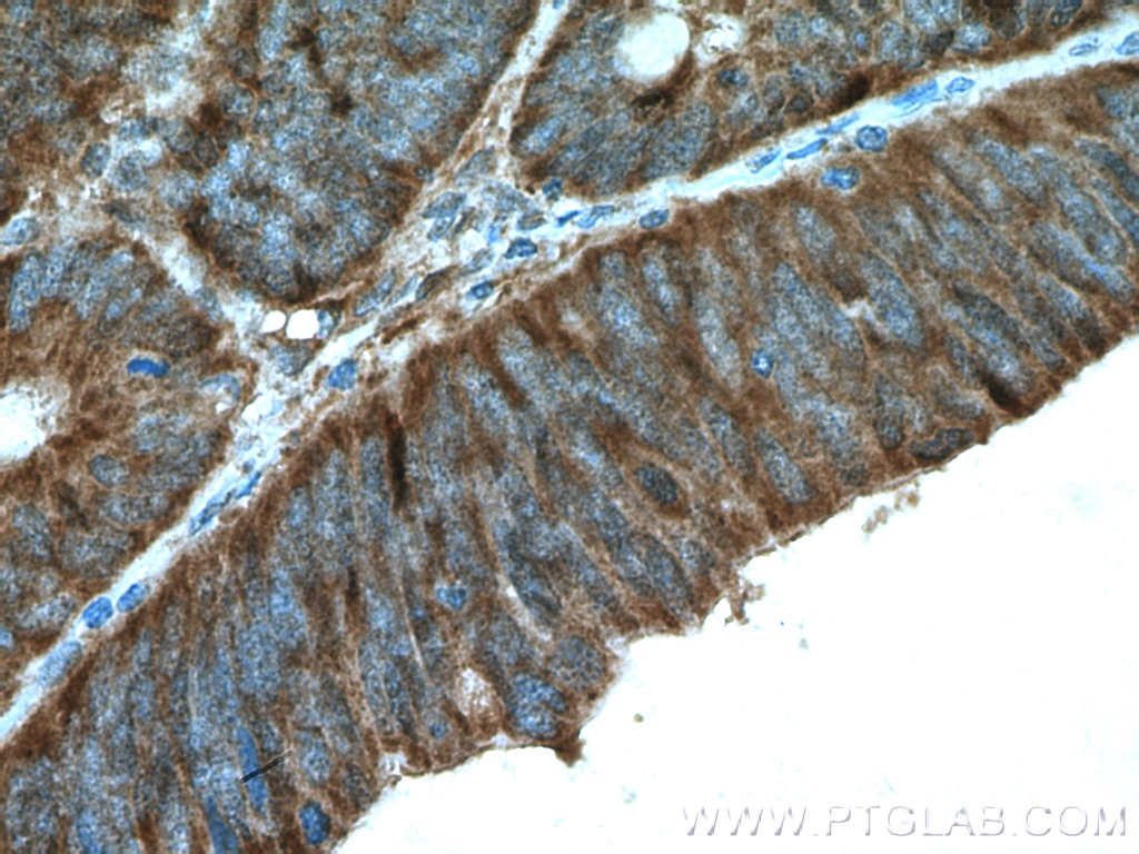 Immunohistochemistry (IHC) staining of human colon cancer tissue using ERK1/2 Polyclonal antibody (11257-1-AP)