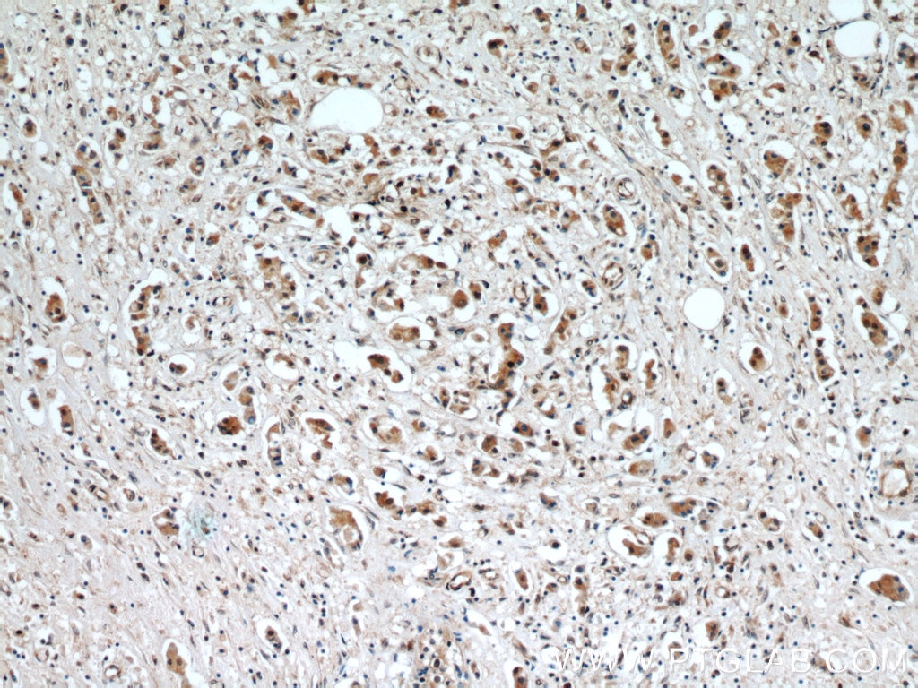 Immunohistochemistry (IHC) staining of human breast cancer tissue using ERK1/2 Polyclonal antibody (11257-1-AP)