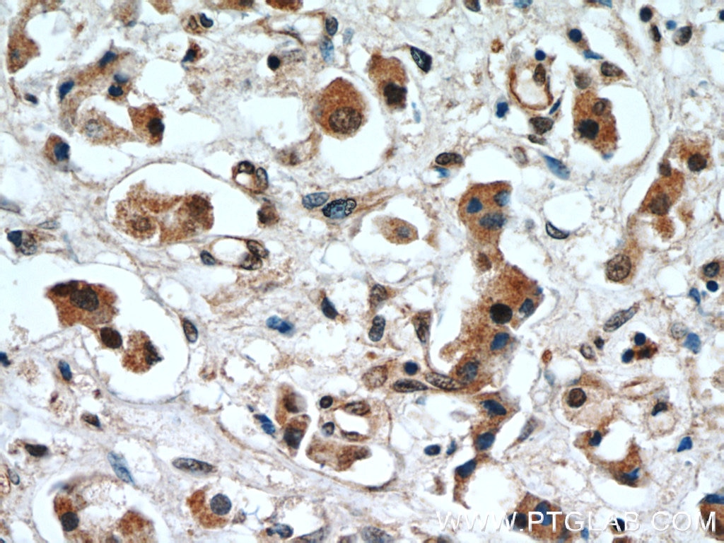 Immunohistochemistry (IHC) staining of human breast cancer tissue using ERK1/2 Polyclonal antibody (11257-1-AP)