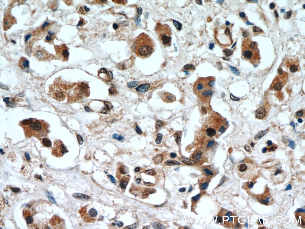 IHC staining of human breast cancer using 11257-1-AP