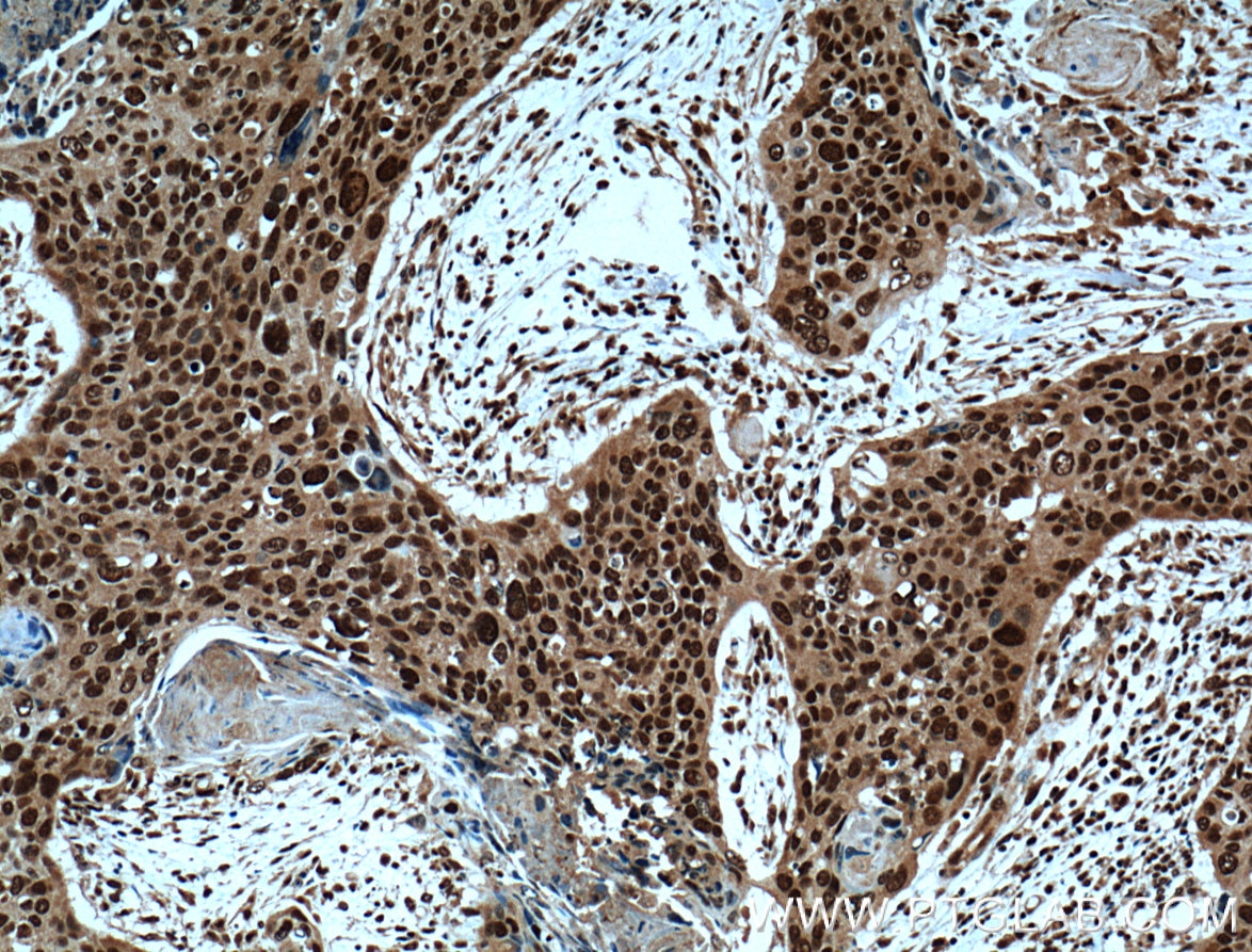 Immunohistochemistry (IHC) staining of human cervical cancer tissue using ERK1/2 Polyclonal antibody (51068-1-AP)