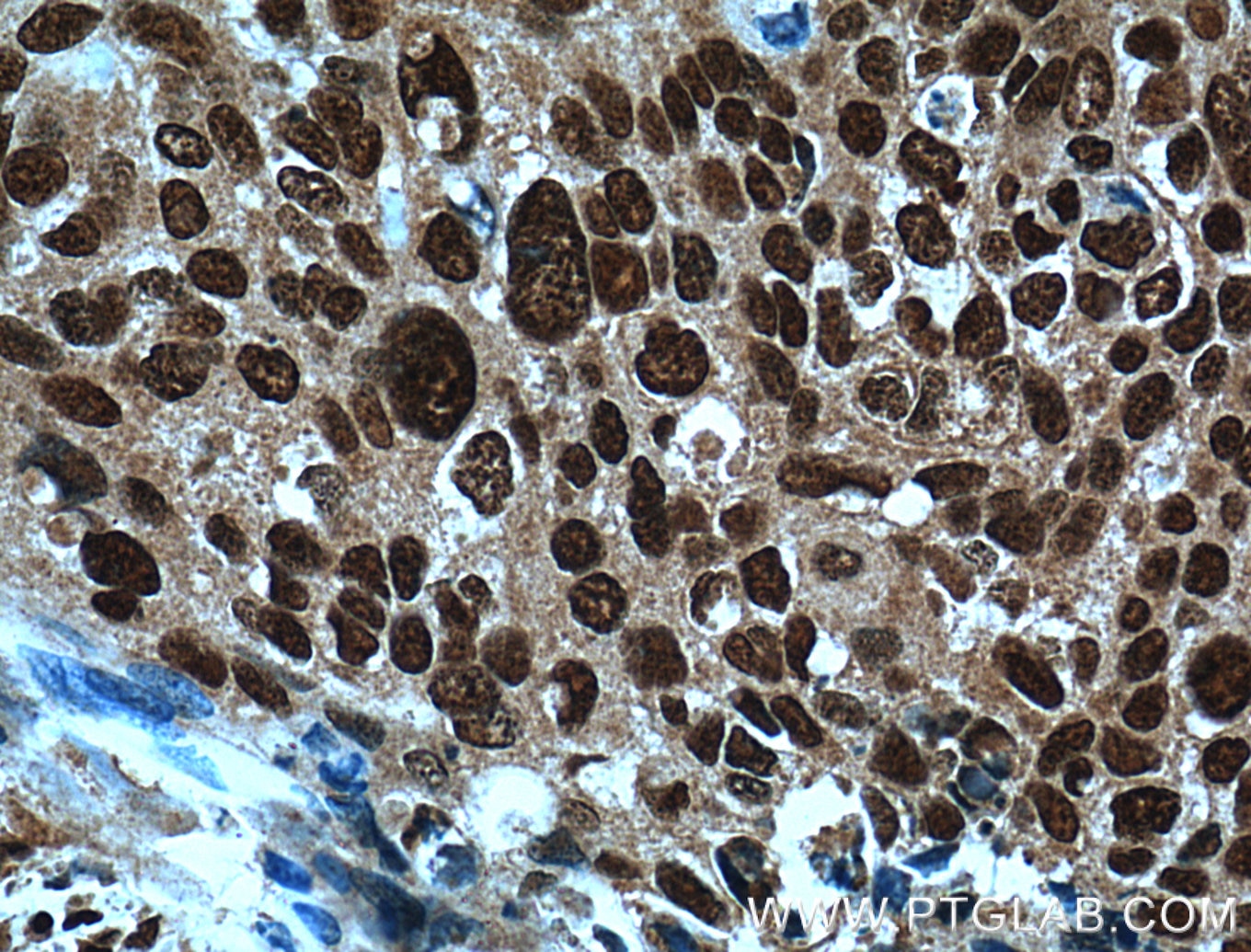 Immunohistochemistry (IHC) staining of human cervical cancer tissue using ERK1/2 Polyclonal antibody (51068-1-AP)