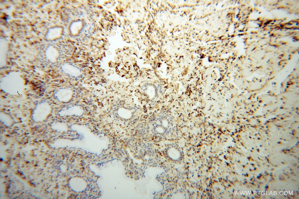 Immunohistochemistry (IHC) staining of human cervical cancer tissue using ERK1/2 Polyclonal antibody (51068-1-AP)