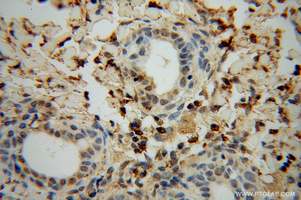 Immunohistochemistry (IHC) staining of human cervical cancer tissue using ERK1/2 Polyclonal antibody (51068-1-AP)