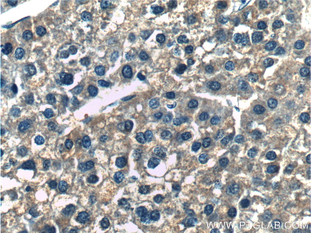 Immunohistochemistry (IHC) staining of human liver cancer tissue using ERLIN2 Polyclonal antibody (14781-1-AP)