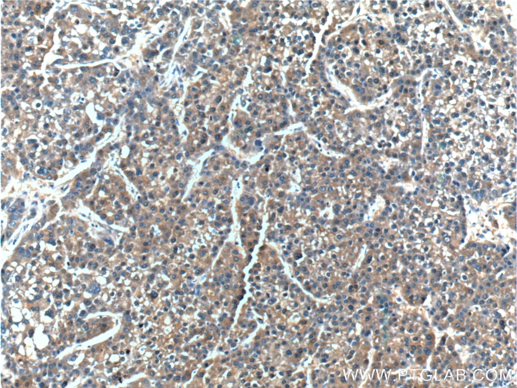 Immunohistochemistry (IHC) staining of human liver cancer tissue using ERLIN2 Polyclonal antibody (14781-1-AP)