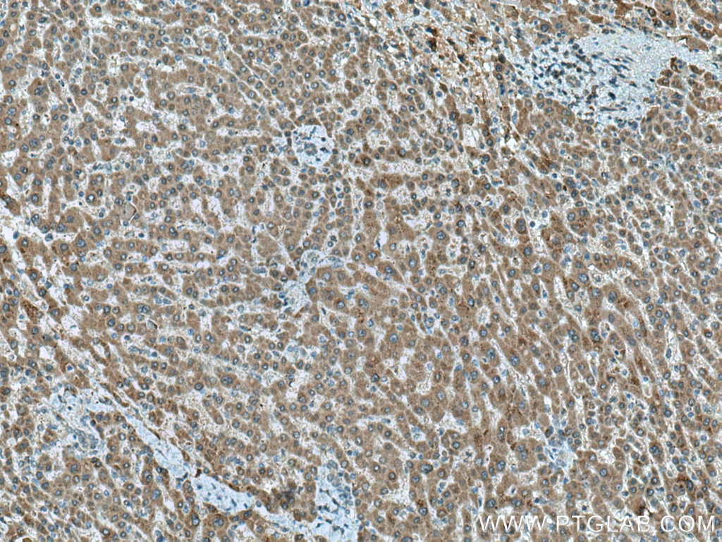 IHC staining of human liver cancer using 67289-1-Ig