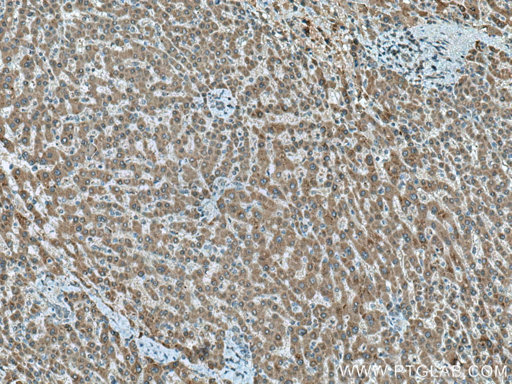 Immunohistochemistry (IHC) staining of human liver cancer tissue using ERN2 Monoclonal antibody (67289-1-Ig)