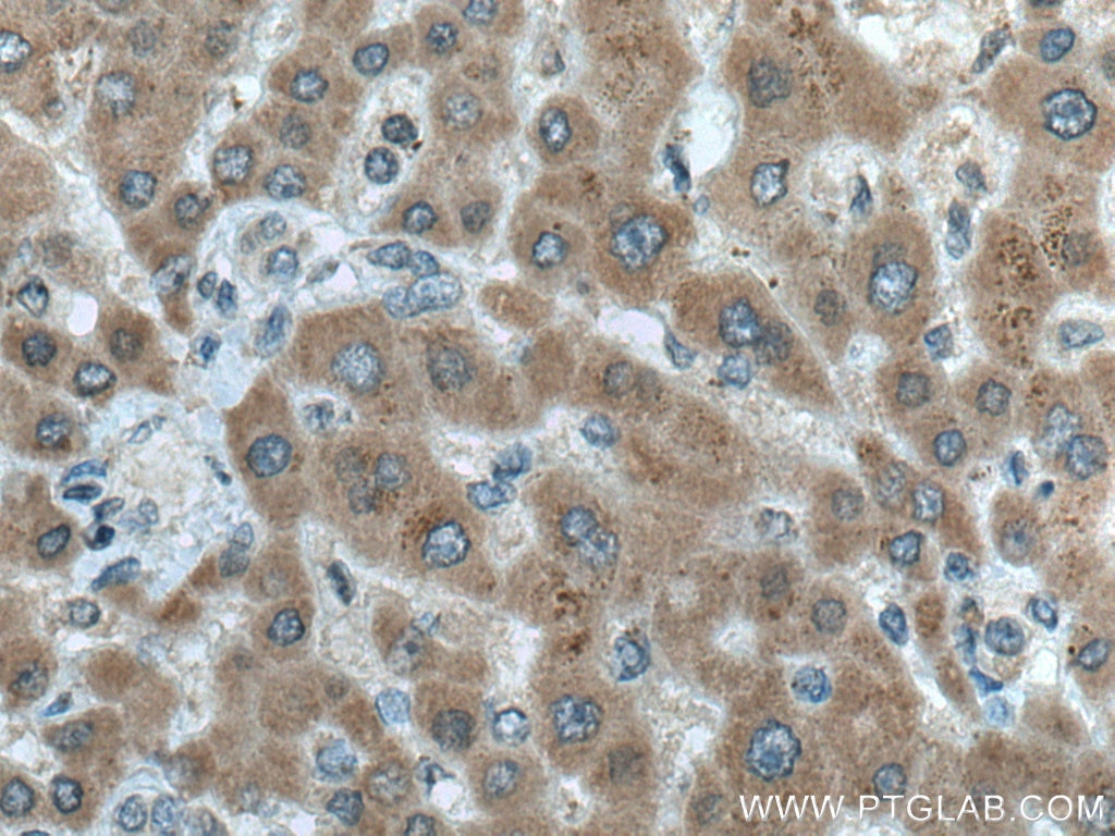 Immunohistochemistry (IHC) staining of human liver cancer tissue using ERN2 Monoclonal antibody (67289-1-Ig)