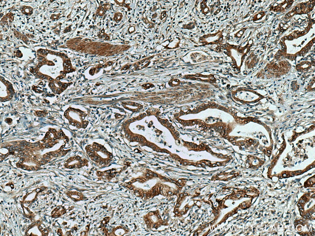 Immunohistochemistry (IHC) staining of human pancreas cancer tissue using ERO1L Polyclonal antibody (12007-1-AP)