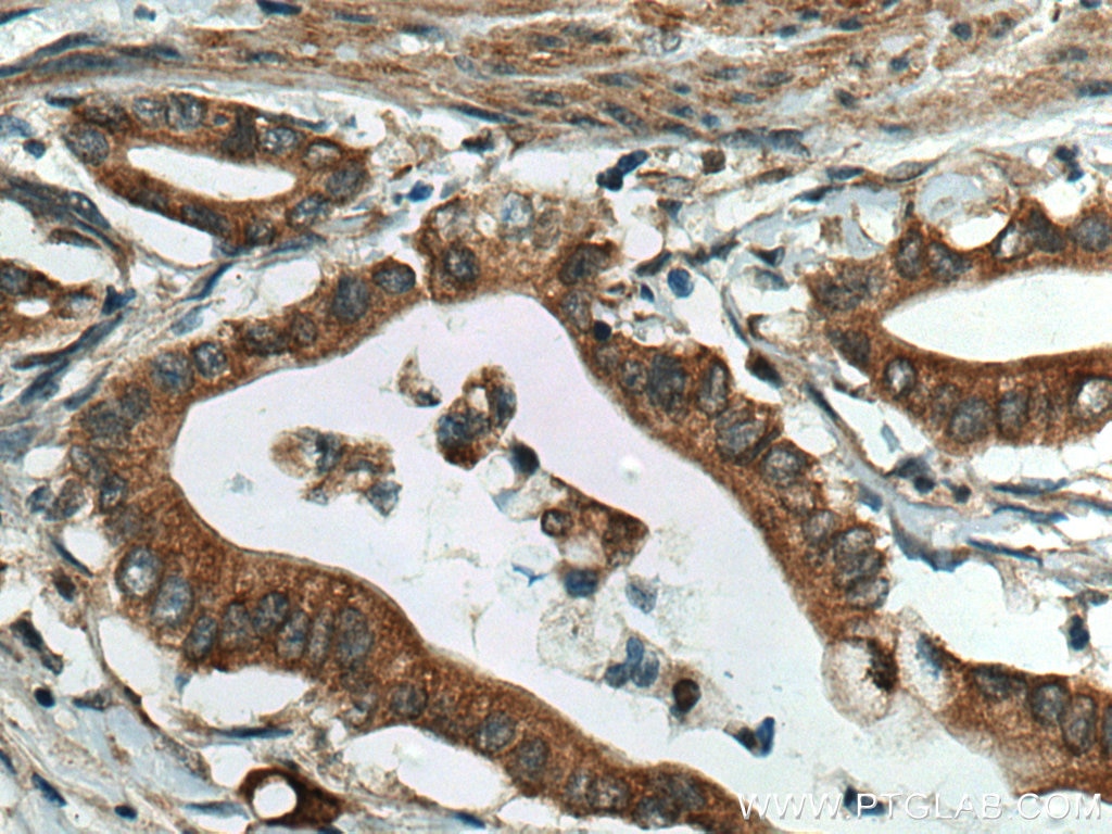 Immunohistochemistry (IHC) staining of human pancreas cancer tissue using ERO1L Polyclonal antibody (12007-1-AP)