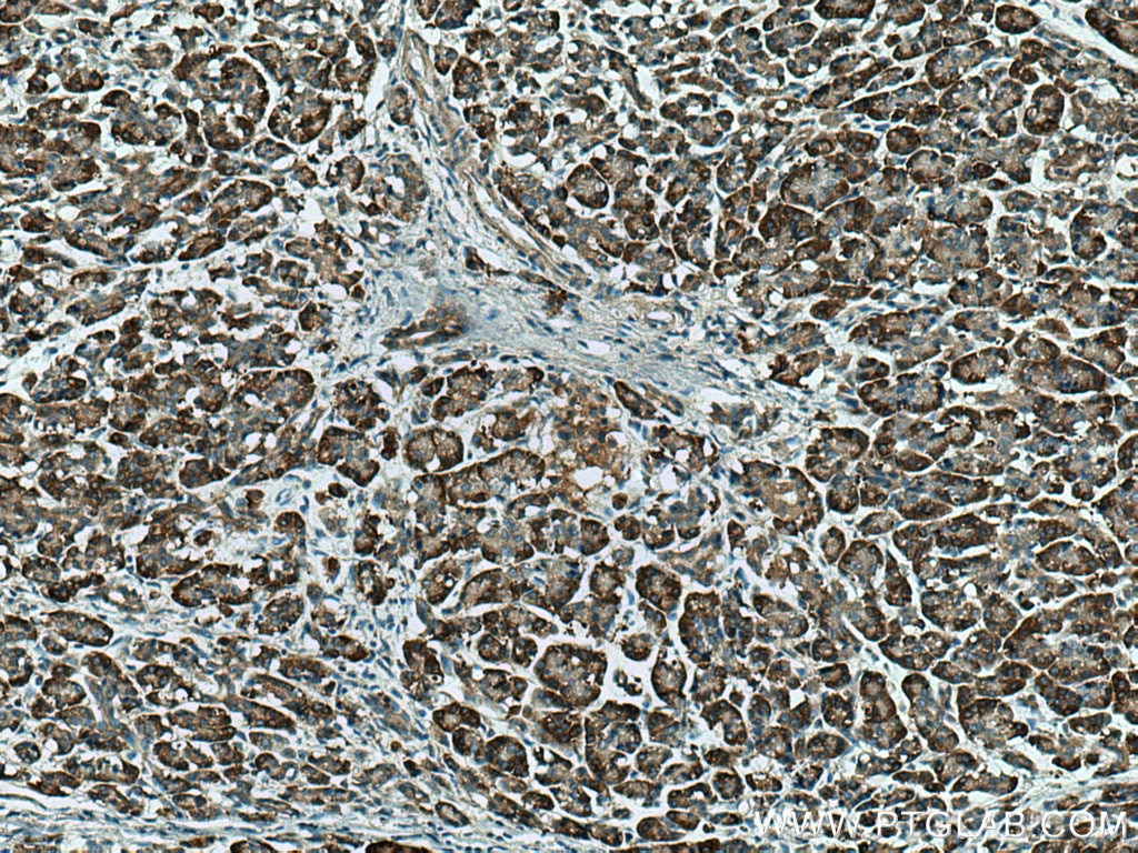 Immunohistochemistry (IHC) staining of human pancreas cancer tissue using ERO1L Polyclonal antibody (12007-1-AP)