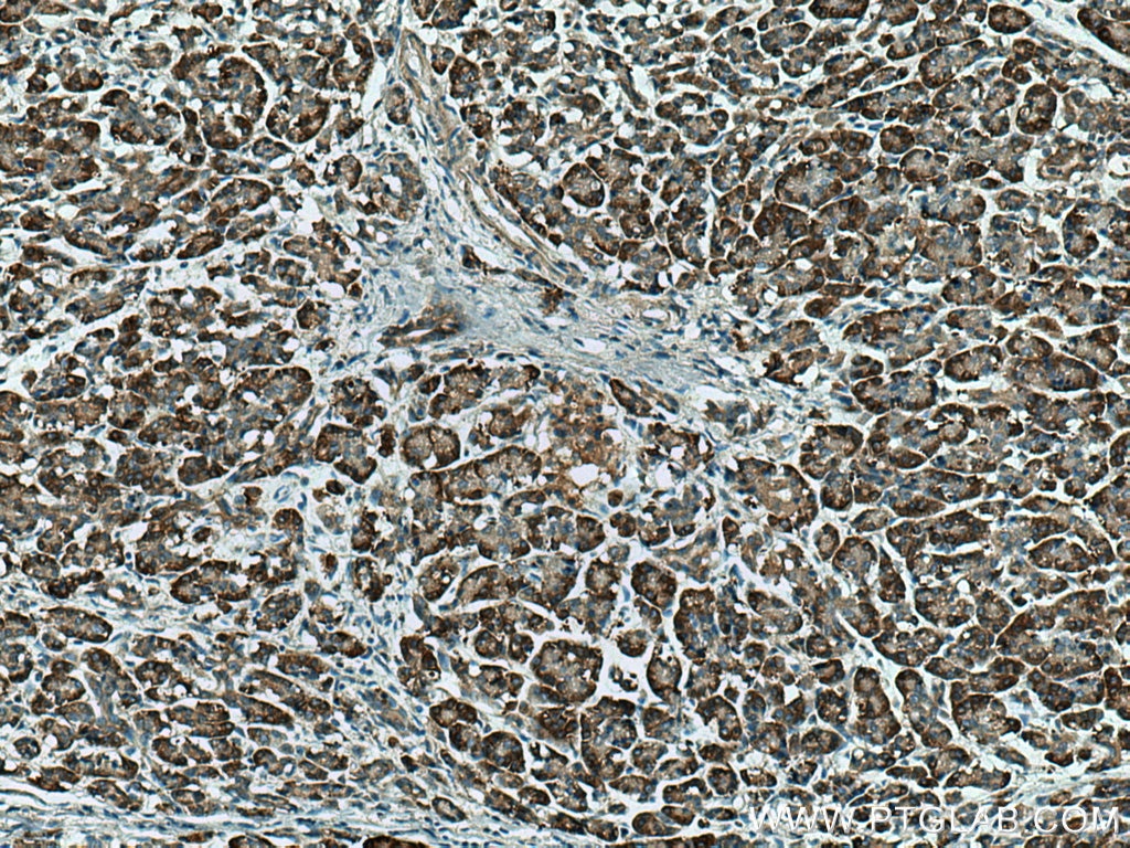 IHC staining of human pancreas cancer using 12007-1-AP