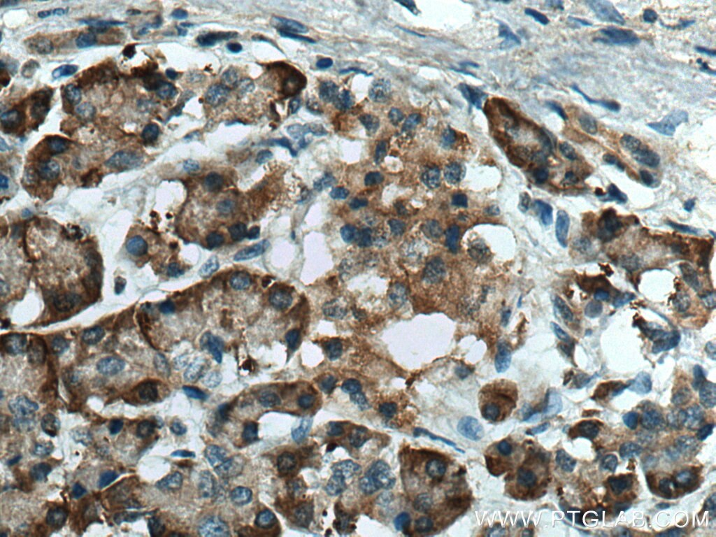 Immunohistochemistry (IHC) staining of human pancreas cancer tissue using ERO1L Polyclonal antibody (12007-1-AP)