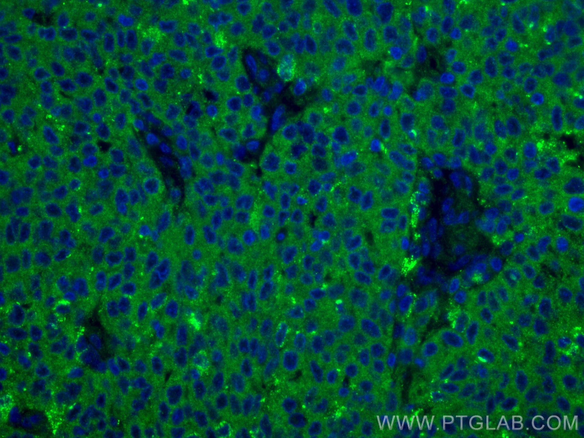 Immunofluorescence (IF) / fluorescent staining of human stomach cancer tissue using ERO1L Monoclonal antibody (67416-1-Ig)