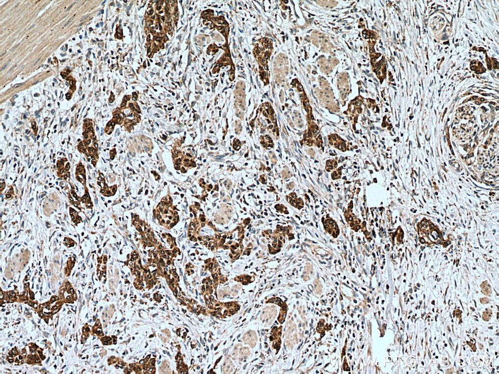 Immunohistochemistry (IHC) staining of human stomach cancer tissue using ERO1L Monoclonal antibody (67416-1-Ig)