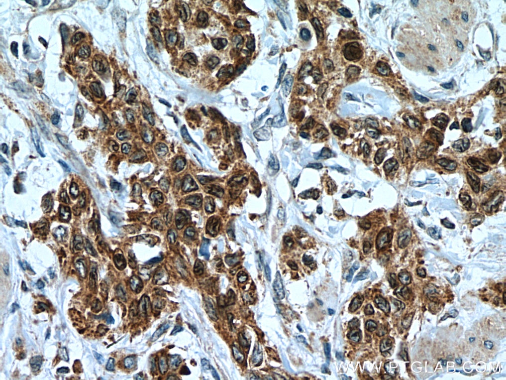 Immunohistochemistry (IHC) staining of human stomach cancer tissue using ERO1L Monoclonal antibody (67416-1-Ig)