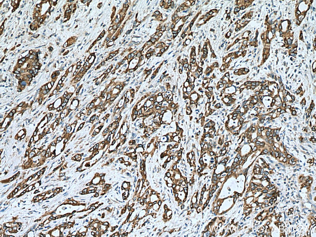 Immunohistochemistry (IHC) staining of human pancreas cancer tissue using ERO1L Monoclonal antibody (67416-1-Ig)