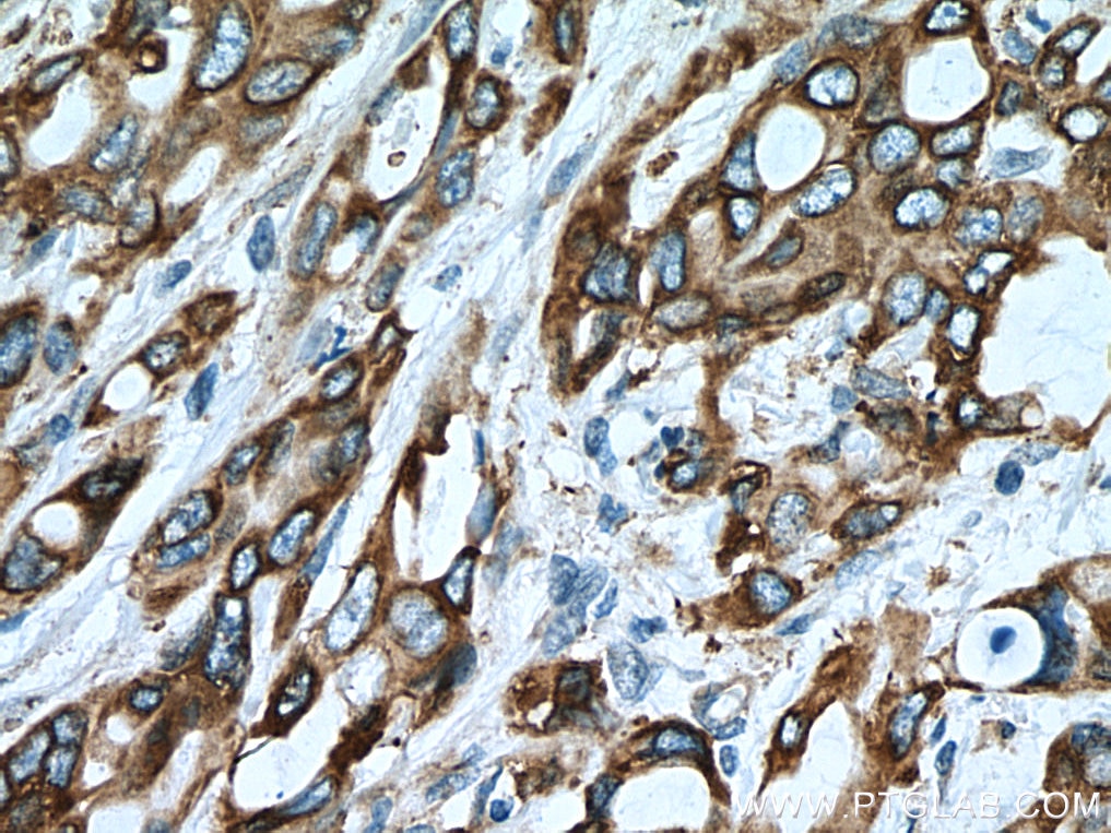 Immunohistochemistry (IHC) staining of human pancreas cancer tissue using ERO1L Monoclonal antibody (67416-1-Ig)