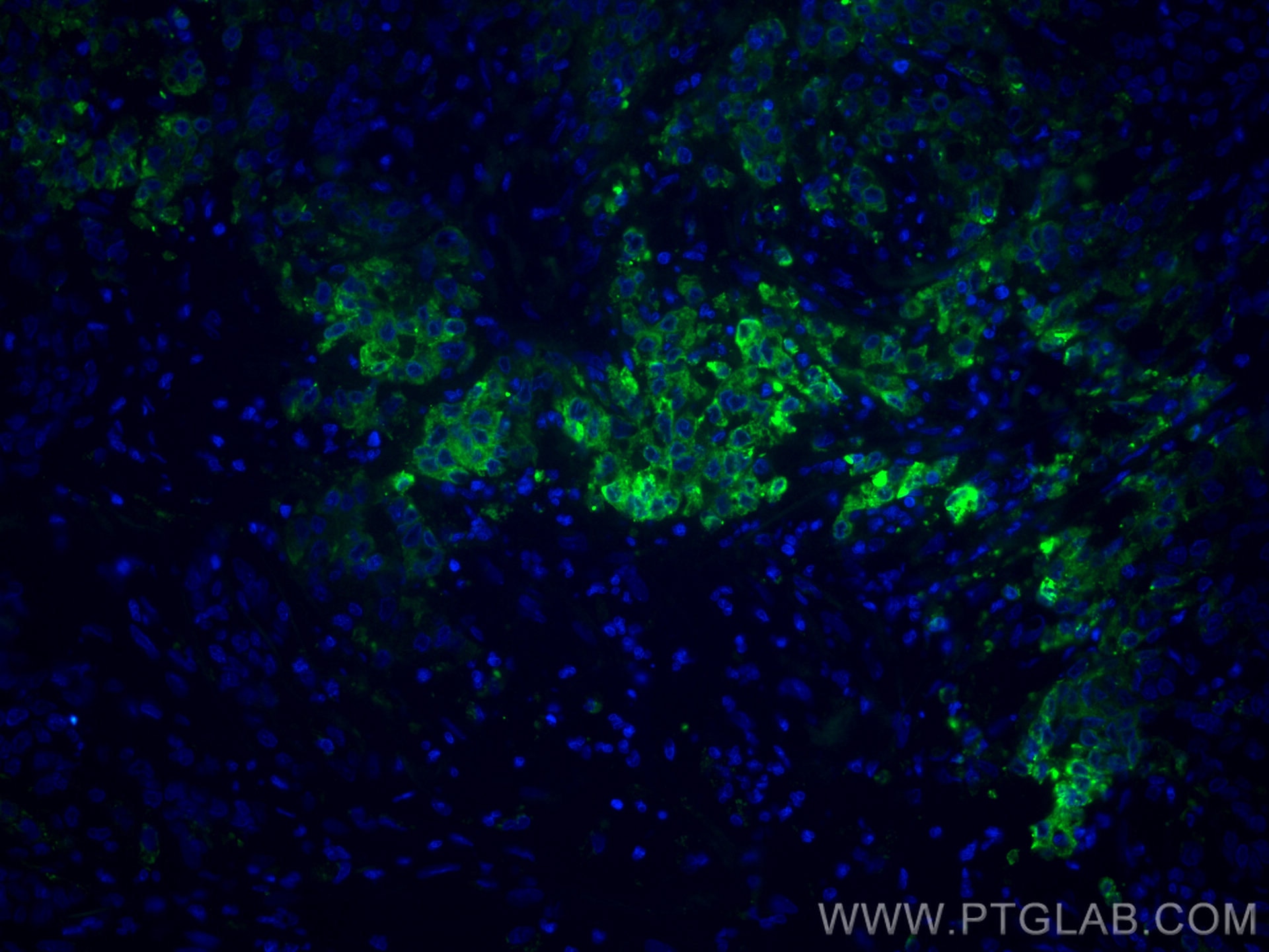 Immunofluorescence (IF) / fluorescent staining of human stomach cancer tissue using CoraLite® Plus 488-conjugated ERO1L Monoclonal ant (CL488-67416)