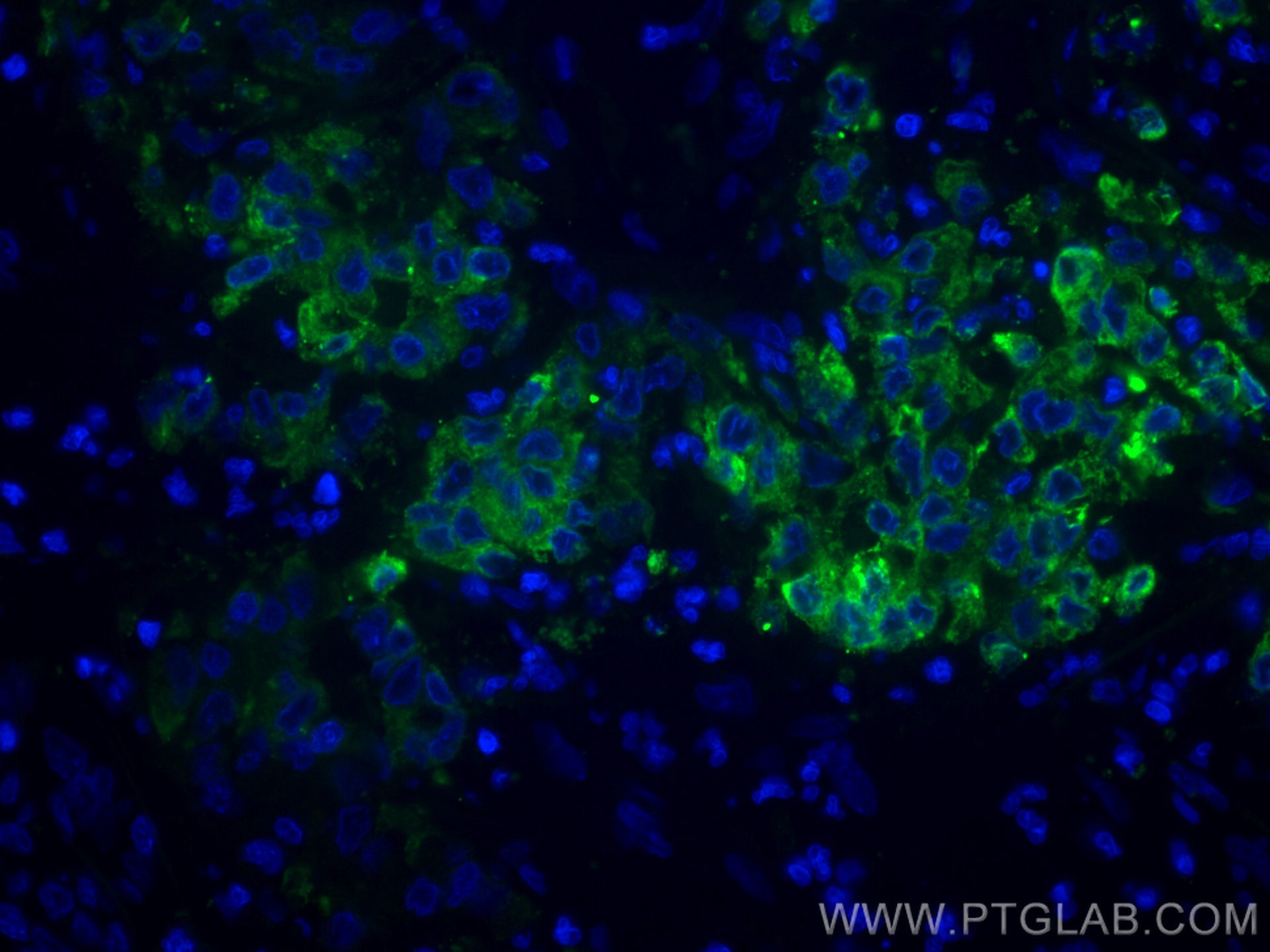 Immunofluorescence (IF) / fluorescent staining of human stomach cancer tissue using CoraLite® Plus 488-conjugated ERO1L Monoclonal ant (CL488-67416)