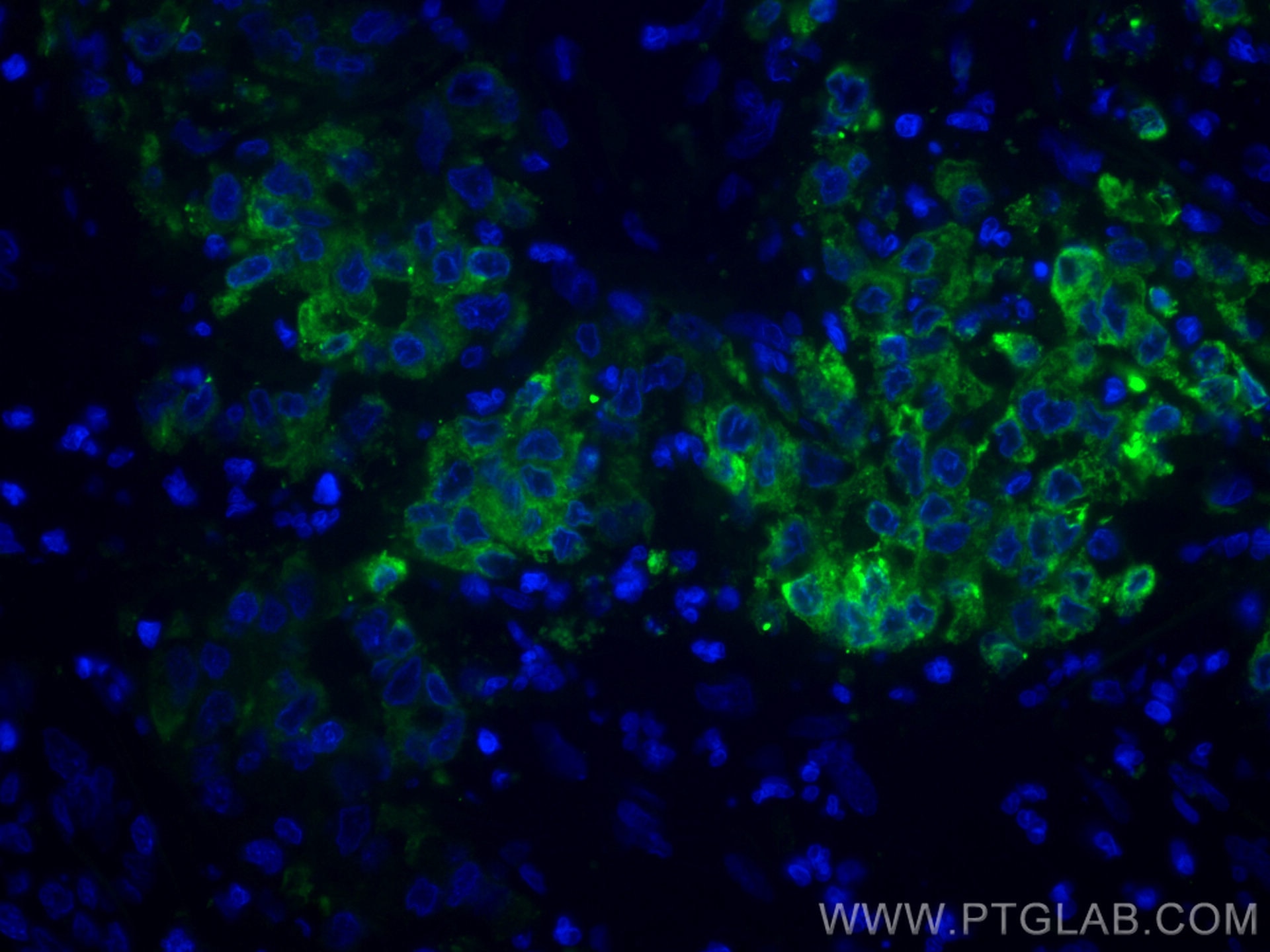 IF Staining of human stomach cancer using CL488-67416