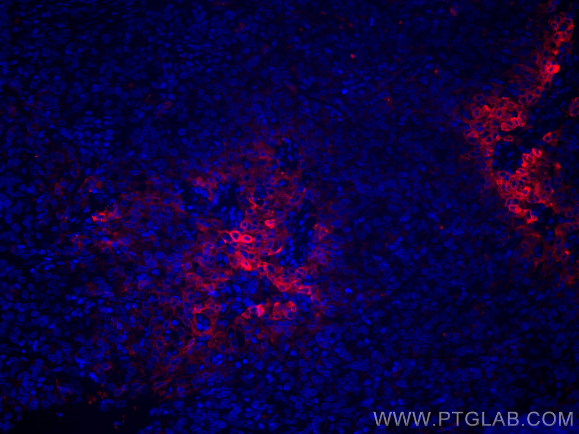 Immunofluorescence (IF) / fluorescent staining of human stomach cancer tissue using CoraLite®594-conjugated ERO1L Monoclonal antibody (CL594-67416)