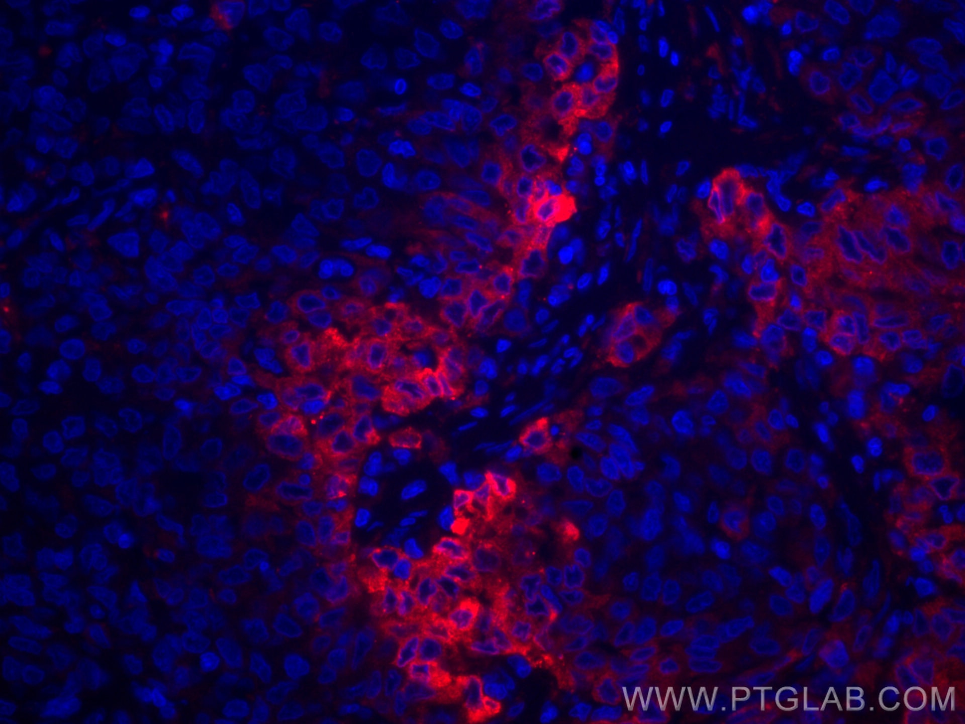 Immunofluorescence (IF) / fluorescent staining of human stomach cancer tissue using CoraLite®594-conjugated ERO1L Monoclonal antibody (CL594-67416)